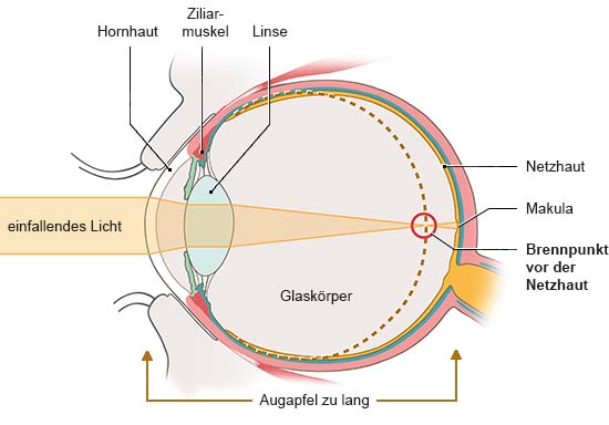 Grafik: Anatomische Darstellung eines Auges in Seitenansicht. Licht trifft nicht gebündelt auf die Netzhaut.