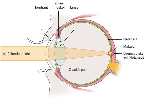 Grafik: Anatomische Darstellung eines Auges in Seitenansicht. Licht trifft gebündelt auf einen Punkt der Netzhaut.