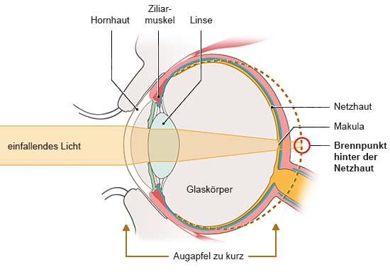 Grafik: Anatomische Darstellung eines Auges in Seitenansicht. Licht trifft nicht gebündelt auf die Netzhaut.