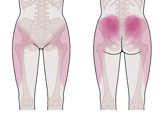 Grafik: Bereiche, in denen Facettenschmerzen auftreten können