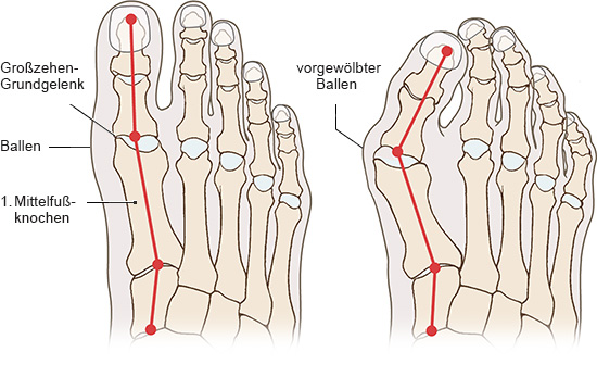 Die Grafik zeigt die anatomische Darstellung eines gesunden Fußes im Vergleich mit einem Hallux valgus.