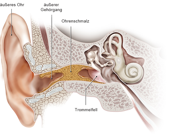 Grafik: Gehörgang mit Ohrenschmalz-Pfropf 