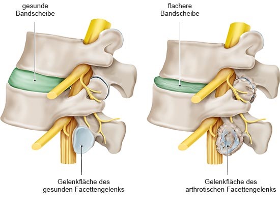 Grafik: Facettengelenk in der Lendenwirbelsäule, links: ohne Arthrose, rechts: mit Arthrose