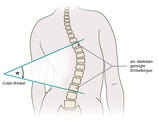 Die Grafik zeigt anhand einer schematischen anatomischen Darstellung des menschlichen Rückens mit Wirbelsäule, wie der Cobb-Winkel bei einer Skoliose ermittelt wird.