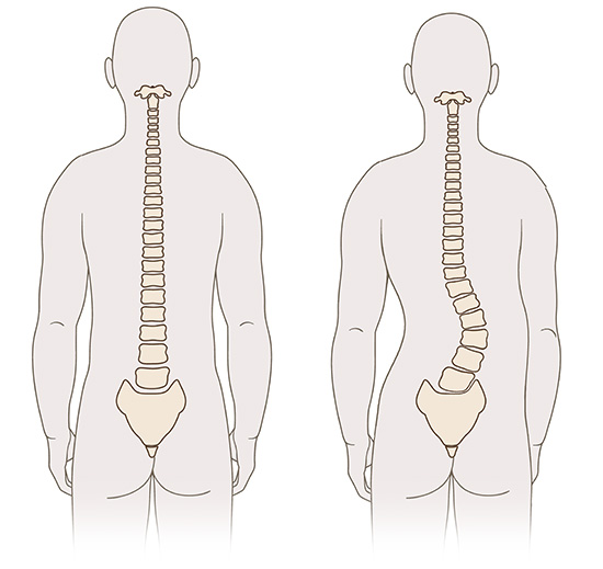 Die Grafik zeigt die schematische anatomische Darstellung einer gesunden Lendenwirbelsäule (links) und einer Lendenwirbelsäule mit Skoliose (rechts).